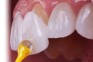 LAMINATE VENEER EMAX LAMINATE VENEER EMAX