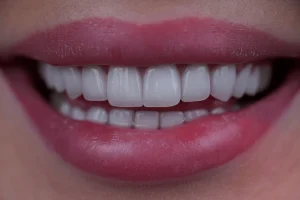 HOLLYWOOD SMILE HOLLYWOOD SMILE