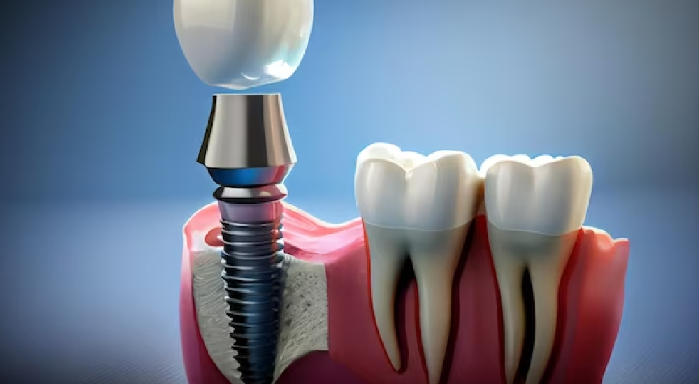Esenyurt'ta 
Kanal Tedavisi / Endodonti Tedavileri ve Fiyatları